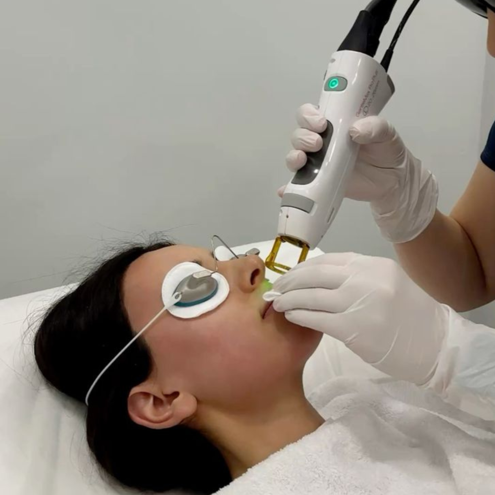 Laser Femme - Offre Perfection 3 séances